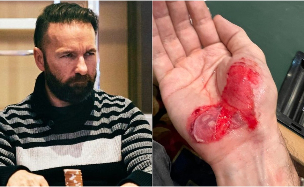 Literally injured, Daniel Negreanu leaves the flagship series of Mind Sport