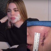 Khloé Kardashian revela sutura en la cara tras eliminación del melanoma
