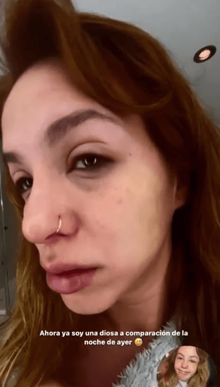 Flor Vigna sufrió una reacción alérgica.