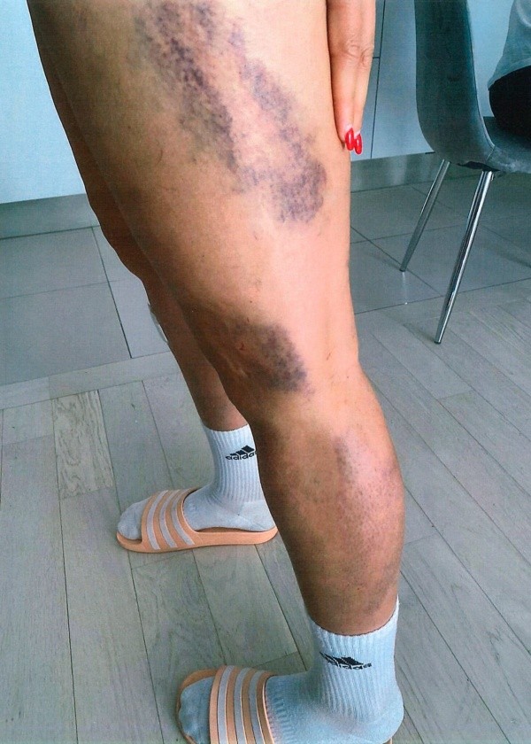 Las lesiones de Hamroui luego de la agresión.