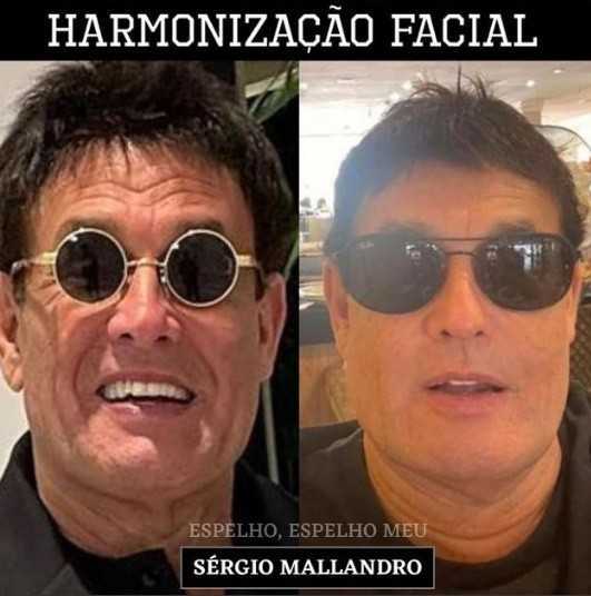 Resultado da harmonização facial de Sérgio Mallandro. Foto: Reprodução/Instagram