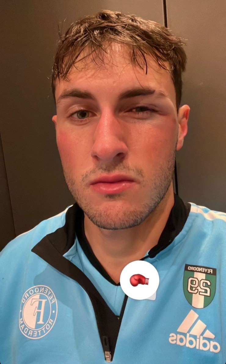 FOTO: Santiago Giménez y su ojo desfigurado