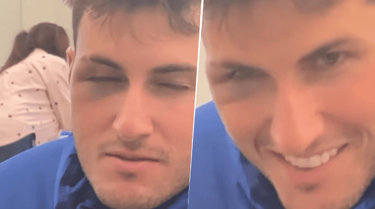 Santiago Giménez y su rostro desfigurado